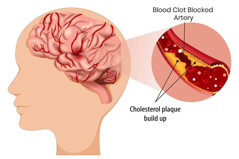Stroke Clinic