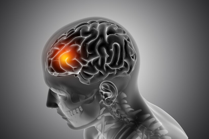 brain tumor 