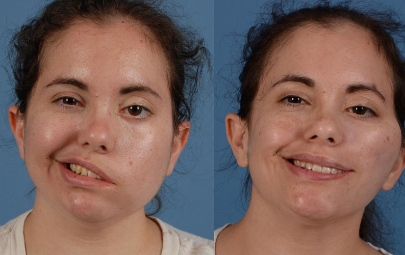Facial Palsy